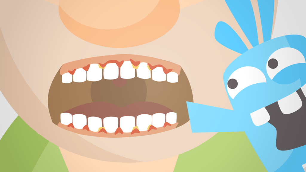 Illustrated image of swollen gums, plaque, and tartar